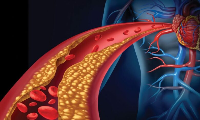 Obratite pažnju: Ovo su česti znakovi visokog holesterola
